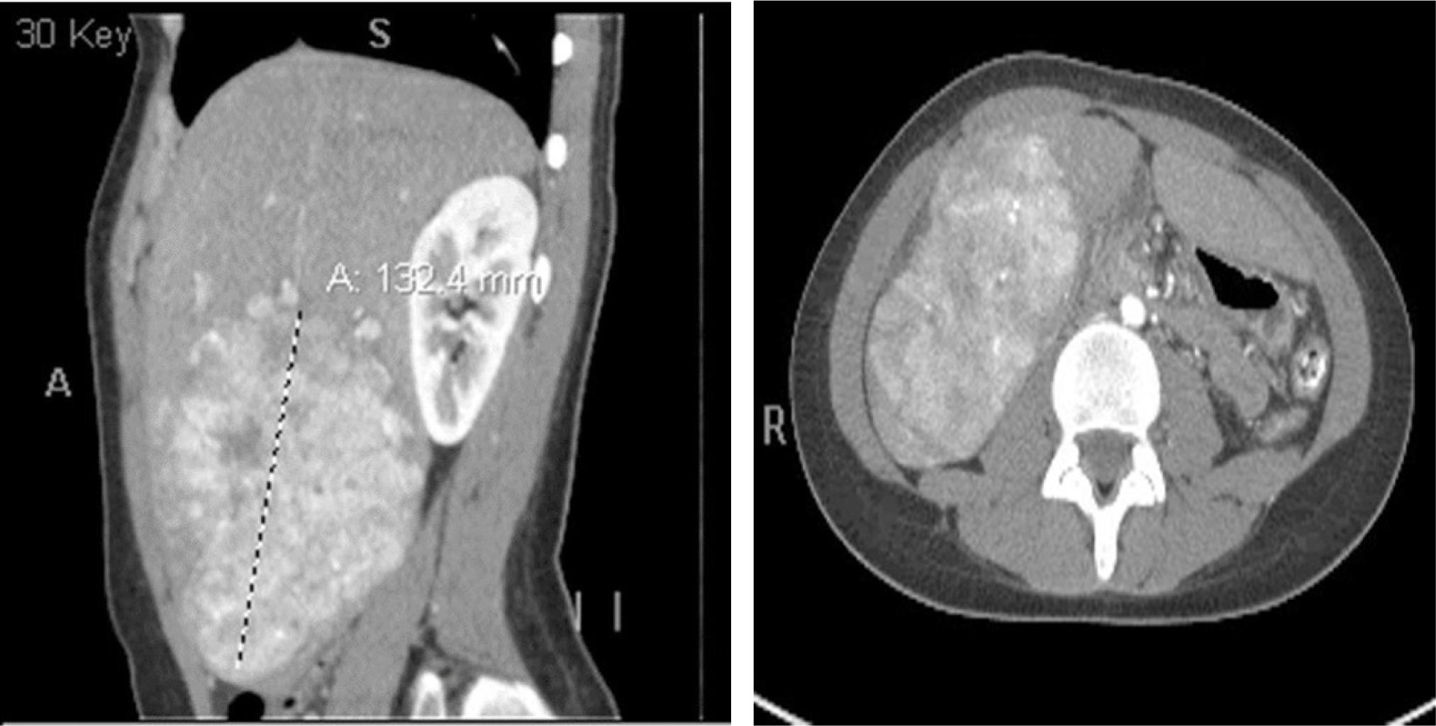 Fibrolamellar Carcinoma with DNAJB1-PRKACA Fusion in a 16-Year-Old: Case  Report and Review of Literature